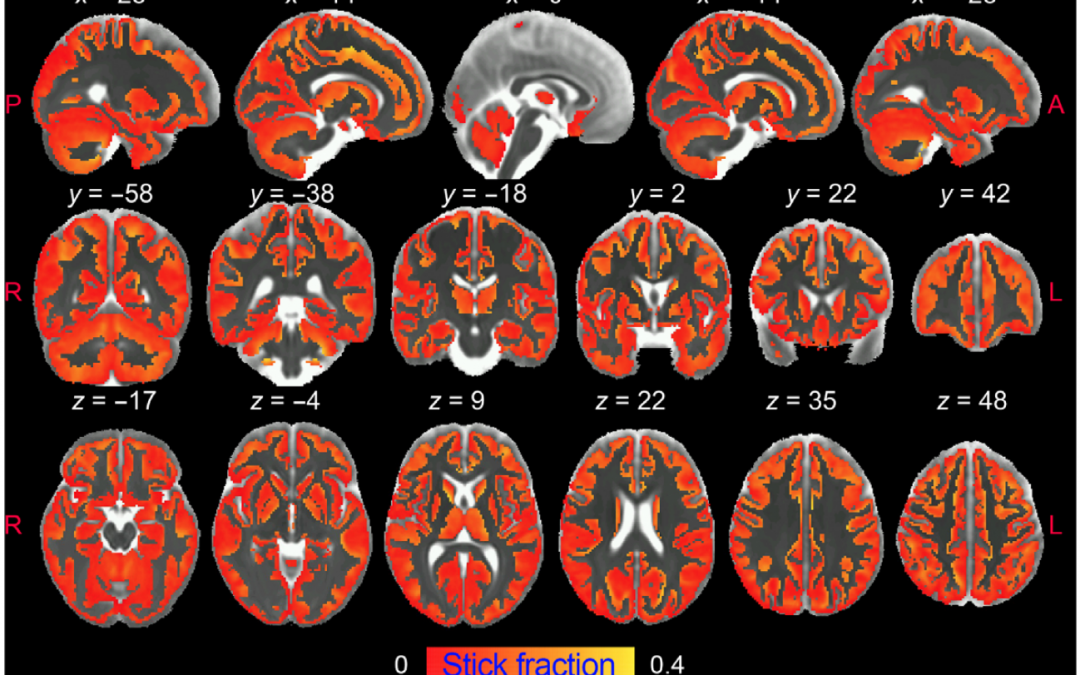 Una resonancia magnética permite ver la inflamación del cerebro ‘in vivo’ por primera vez