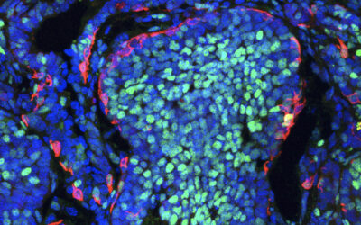 Un nuevo estudio revela que las células cancerosas compiten a favor y en contra del desarrollo del tumor