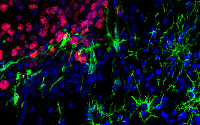 Descubren una nueva estrategia para combatir metástasis cerebrales del cáncer de piel más agresivo